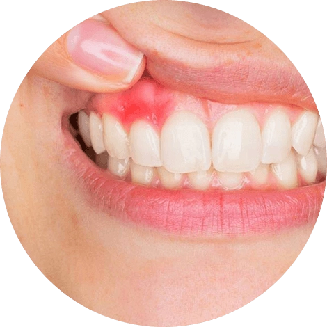 Баннер Лечение пародонтита Баннер Лечение пародонтита